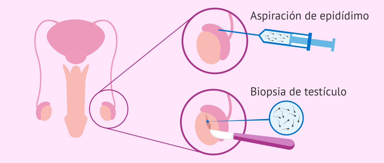 gallery/infertilidad masculia